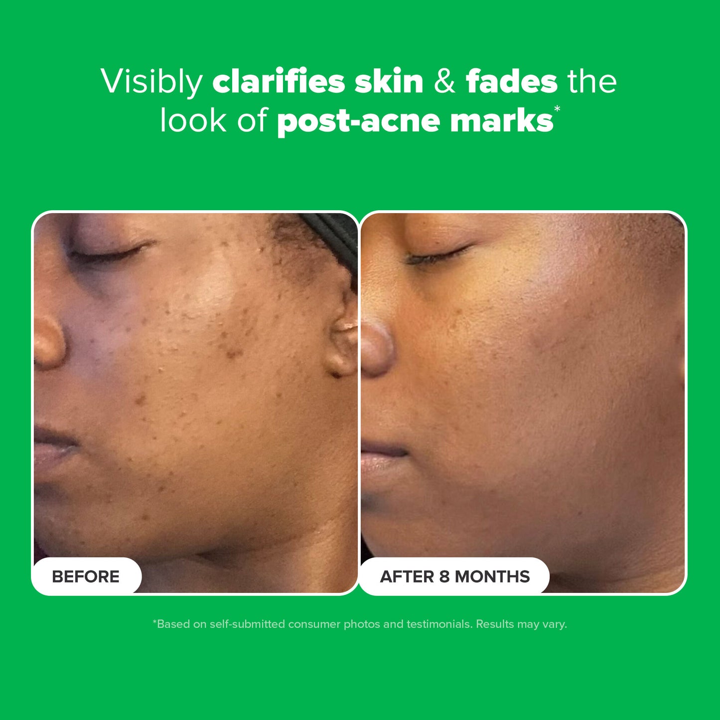 10% Azelaic Acid Booster