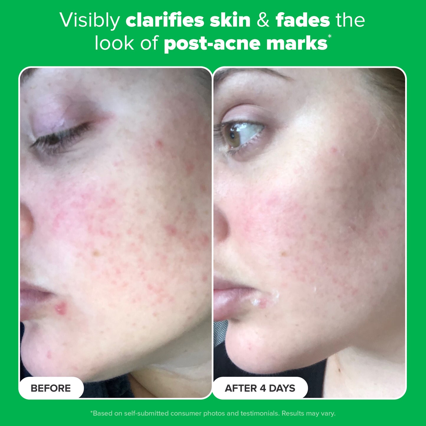 10% Azelaic Acid Booster