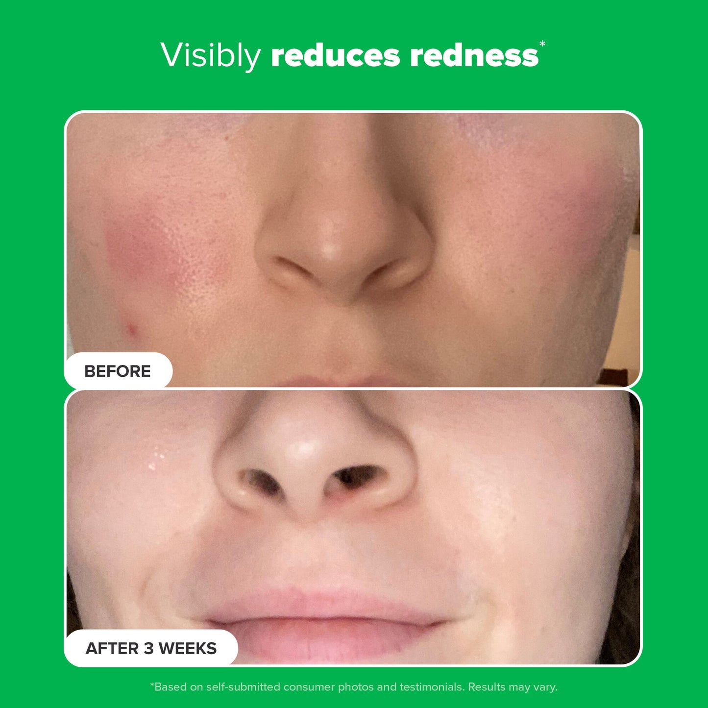 10% Azelaic Acid Booster