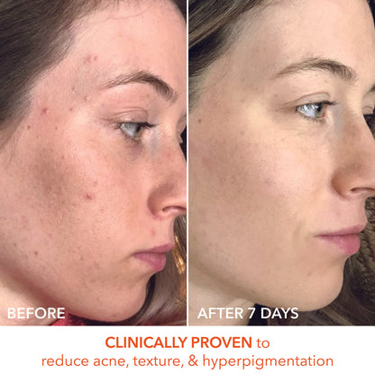 Alpha Beta Universal Daily Peel