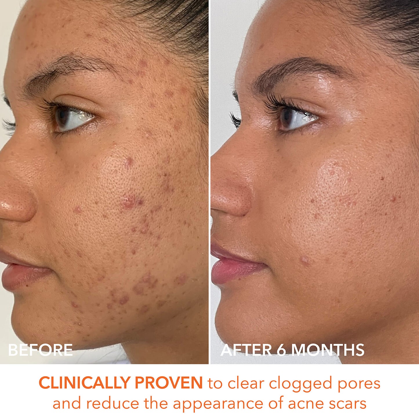 Alpha Beta Peel Extra Strength Formula