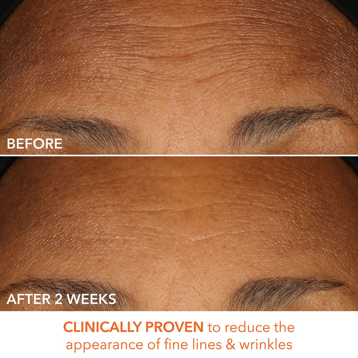 Alpha Beta Peel Extra Strength Formula