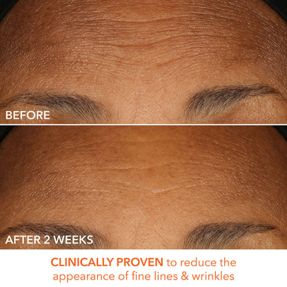 Alpha Beta Peel Extra Strength Formula