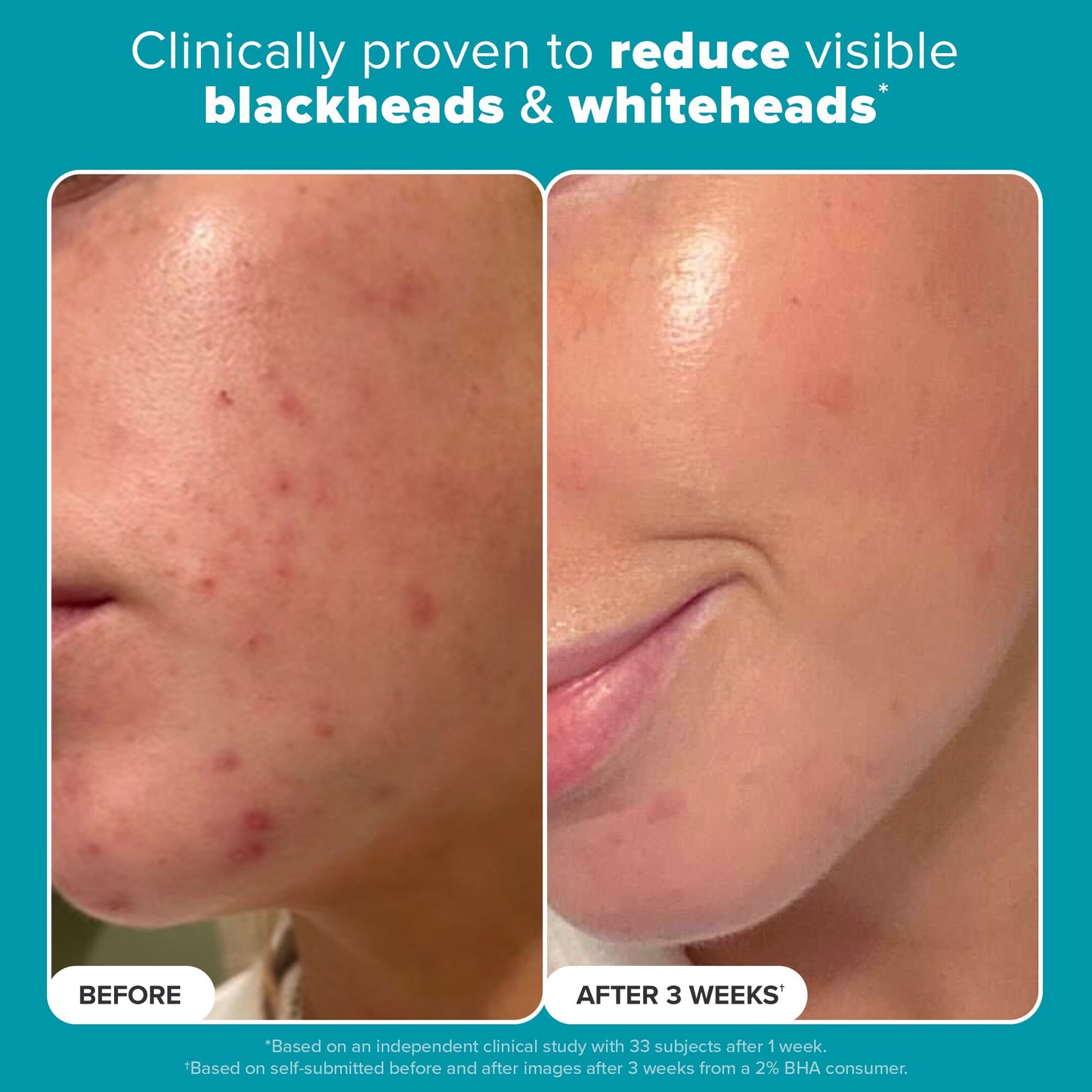 Skin Perfecting 2% BHA Liquid Exfoliant