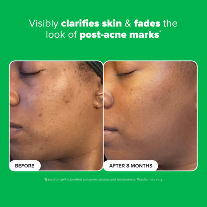 10% Azelaic Acid Booster