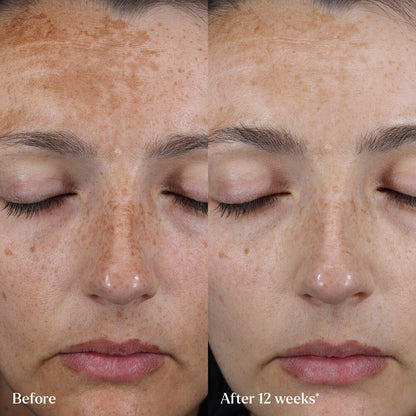 The Hyperpigmentation Serum